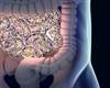 Inflammatory Arthritis and the Gut Microbiome: Do Microbes Hold the Key to New Treatments? Inflammatory Arthritis and the Gut Microbiome: Do Microbes Hold the Key to New Treatments?