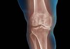 Higher Fibrosis Scores Associated With Lower Radiographic Severity in Knee OA Higher Fibrosis Scores Associated With Lower Radiographic Severity in Knee OA