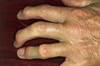 Managing Psoriatic Arthritis: Updated 2018 Recommendations From ACR/NPF Managing Psoriatic Arthritis: Updated 2018 Recommendations From ACR/NPF