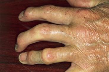 Managing Psoriatic Arthritis: Updated 2018 Recommendations From ACR/NPF Managing Psoriatic Arthritis: Updated 2018 Recommendations From ACR/NPF