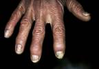 Secukinumab Provides Sustained Remission for Psoriatic Arthritis in Post Hoc Analysis Secukinumab Provides Sustained Remission for Psoriatic Arthritis in Post Hoc Analysis