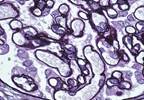 Renal Complications in Rheumatoid Arthritis: Evolution and Management Renal Complications in Rheumatoid Arthritis: Evolution and Management