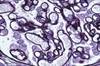 Renal Complications in Rheumatoid Arthritis: Evolution and Management Renal Complications in Rheumatoid Arthritis: Evolution and Management