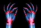 RA Flare Risk Not Predicted by Adalimumab Trough, Antibody Levels RA Flare Risk Not Predicted by Adalimumab Trough, Antibody Levels