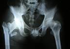 Several Factors Tied to Early Readmission After Hip Fracture Surgery Several Factors Tied to Early Readmission After Hip Fracture Surgery