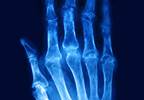 Periarticular Bone Loss Inhibition Linked to Clinical Remission in RA Periarticular Bone Loss Inhibition Linked to Clinical Remission in RA