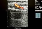 Ulnar Artery Occlusion: A Vasculopathy Severity Marker in SSc Ulnar Artery Occlusion: A Vasculopathy Severity Marker in SSc