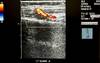 Ulnar Artery Occlusion: A Vasculopathy Severity Marker in Scleroderma Ulnar Artery Occlusion: A Vasculopathy Severity Marker in Scleroderma