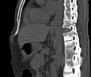 When deciding total hip arthroplasty strategies for patients with AS, spinal sagittal alignment should be considered to provide better joint motion and stability. When deciding total hip arthroplasty strategies for patients with AS, spinal sagittal alignment should be considered to provide better joint motion and stability.