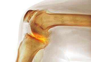 Hormone therapy in postmenopausal women may be protective against knee OA. Hormone therapy in postmenopausal women may be protective against knee OA.