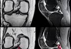 Meniscal Damage Predicts Development of Accelerated Knee Osteoarthritis Meniscal Damage Predicts Development of Accelerated Knee Osteoarthritis