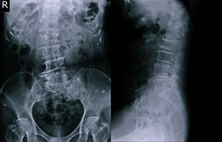 Secukinumab provided sustained efficacy on signs and symptoms through 4 years of treatment. Secukinumab provided sustained efficacy on signs and symptoms through 4 years of treatment.