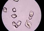 Anakinra Use Assessed in Hospitalized Patients With Crystal-Associated Arthritis Anakinra Use Assessed in Hospitalized Patients With Crystal-Associated Arthritis