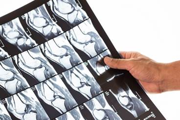 No Benefit for MRI-Guided Treat-to-Target Strategy in Rheumatoid Arthritis No Benefit for MRI-Guided Treat-to-Target Strategy in Rheumatoid Arthritis