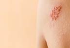 Effects of TNFi Therapy on Herpes Zoster Risk in Rheumatoid Arthritis Effects of TNFi Therapy on Herpes Zoster Risk in Rheumatoid Arthritis