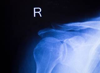 The incidence rate of upper limb joint replacements has decreased since 2002 among patients with rheumatoid arthritis. The incidence rate of upper limb joint replacements has decreased since 2002 among patients with rheumatoid arthritis.