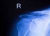 Upper Limb Joint Replacements Decreasing Among Patients With RA Upper Limb Joint Replacements Decreasing Among Patients With RA