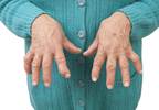 Clinical, Radiographic Benefits of Tofacitinib Sustained for 2 Years in Rheumatoid Arthritis Clinical, Radiographic Benefits of Tofacitinib Sustained for 2 Years in Rheumatoid Arthritis