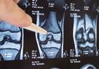 Subchondral Pathology Independently Associated With Knee Osteoarthritis Subchondral Pathology Independently Associated With Knee Osteoarthritis